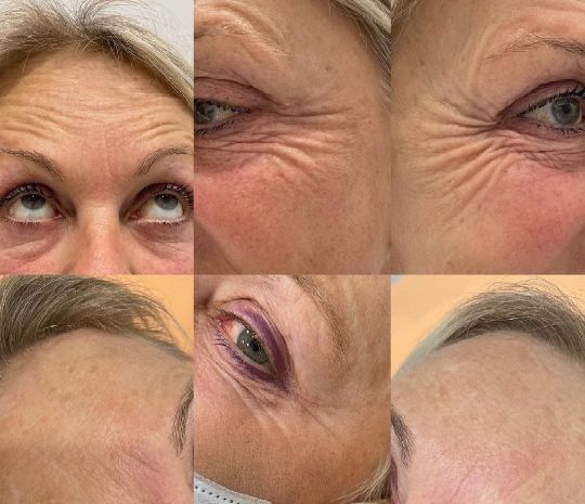 ЛАЗЕРНЕ ШЛІФУВАННЯ ОБЛИЧЧЯ АБО ТІЛА