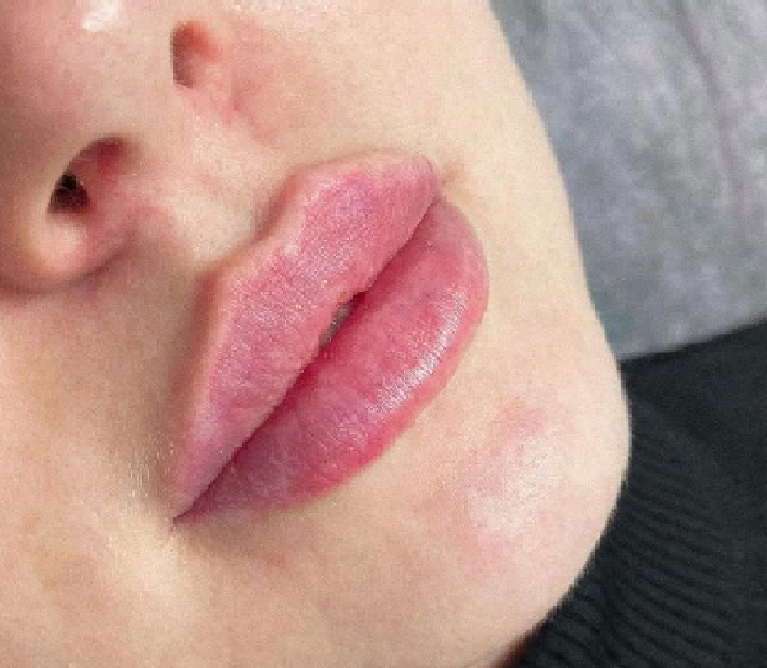 ЛАЗЕРНЕ ШЛІФУВАННЯ ОБЛИЧЧЯ АБО ТІЛА